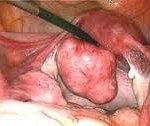 This fibroid may not require urgent treatment.